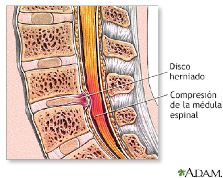 Sabes qu es la hernia de disco